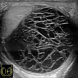 Scrotal ultrasonography of hematocele